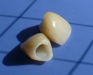 オールセラミック